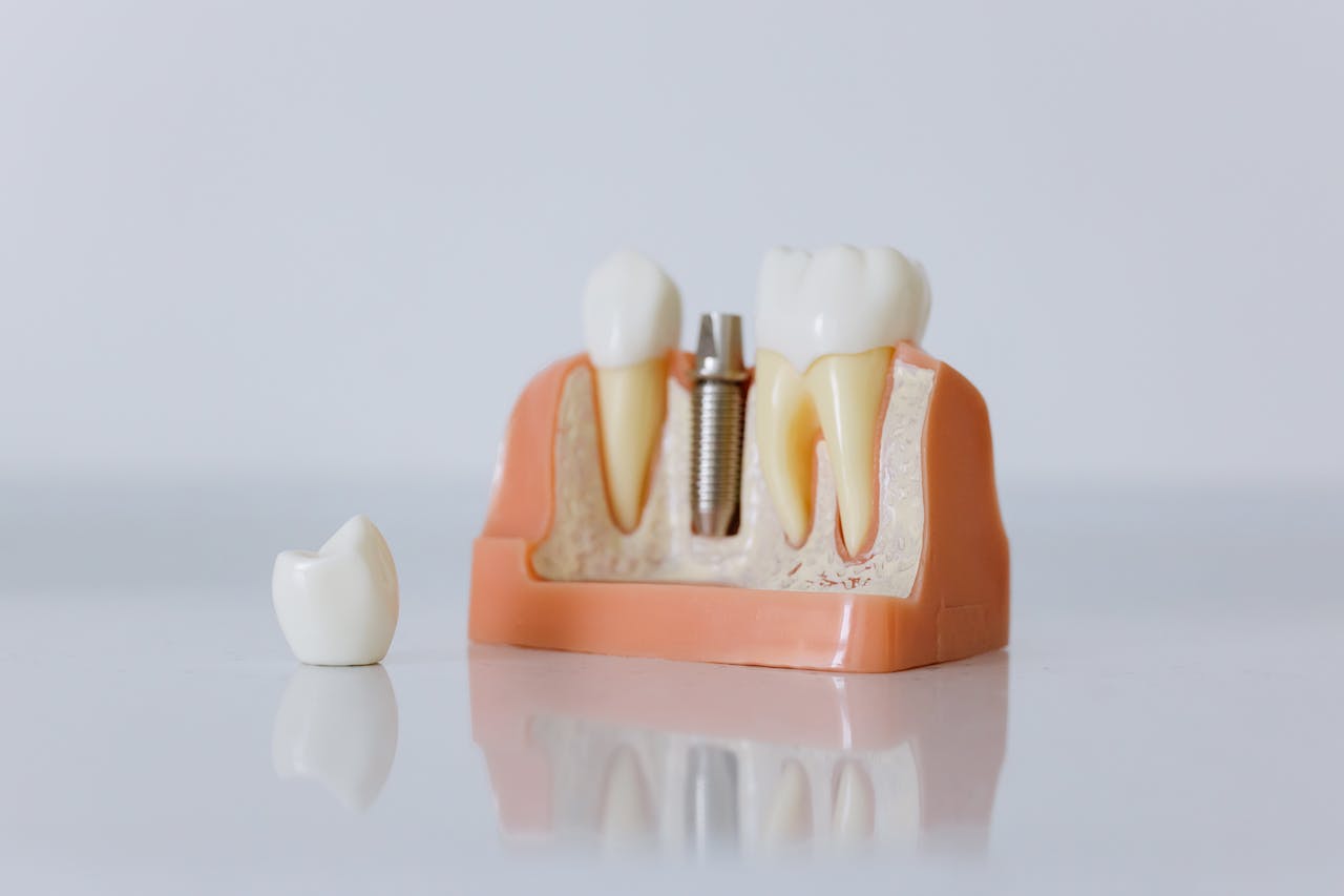 Czym jest implant zębowy?